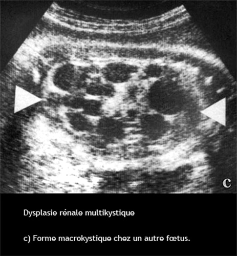 Dysplasie Renale 2 - Dr KARA-ZAITRI M.A