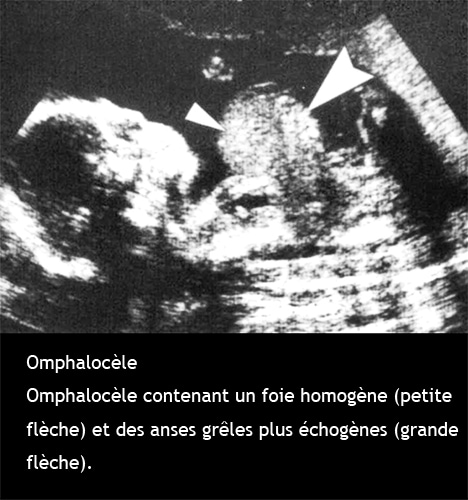 Omphaloc le 2 Dr KARA ZAITRI M A omphaloc-le-2-dr-kara-zaitri-m-a