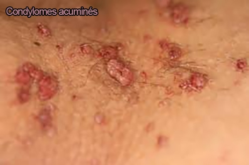 Condylomes 3 - Dr KARA-ZAITRI M.A