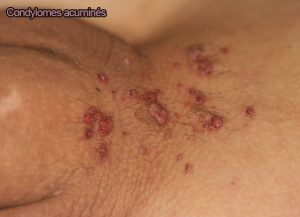 Condylomes 4 - Dr KARA-ZAITRI M.A