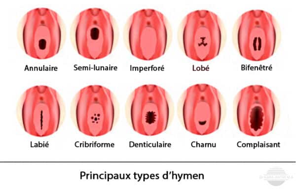 Hymen - Dr KARA-ZAITRI M.A - Gynécologue-Obstétricien