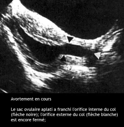 Avortement en cours — fausse couche spontanée échographie 2