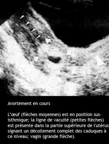 Avortement en cours — fausse couche spontanée échographie 3