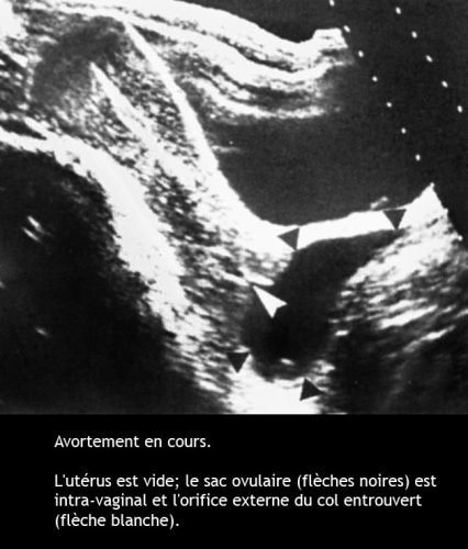 Avortement en cours — fausse couche spontanée image échographique