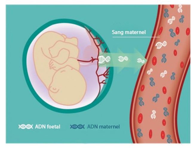 ADN fœtal — diagnostic prénatal non invasif DPNI génétique