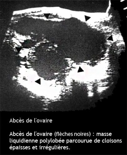 Abcès de l'ovaire