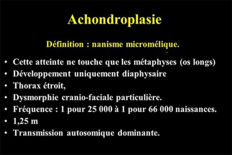 Achondroplasie — nanisme chondrodystrophique malformation osseuse 2