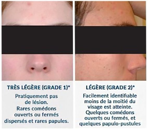 Acné hormonale — manifestations cutanées hyperandrogénie féminine 1