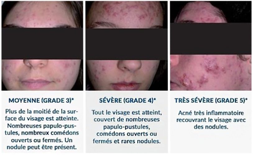 Acné hormonale — manifestations cutanées hyperandrogénie féminine 2