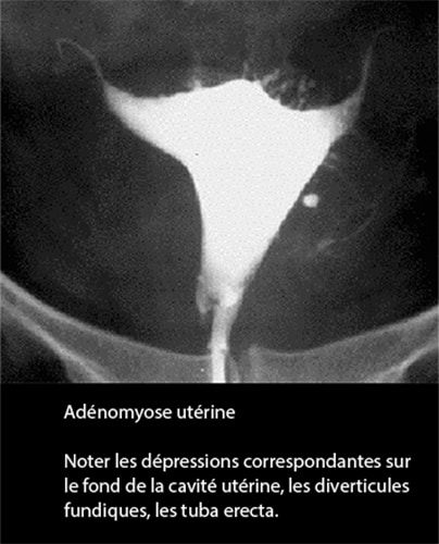 Adénomyose 1
