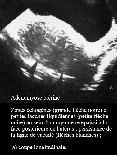 Adenomyose 1