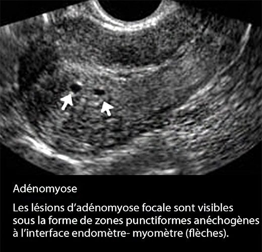 Adenomyose 10