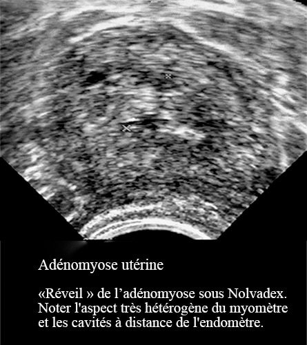 Adenomyose 12
