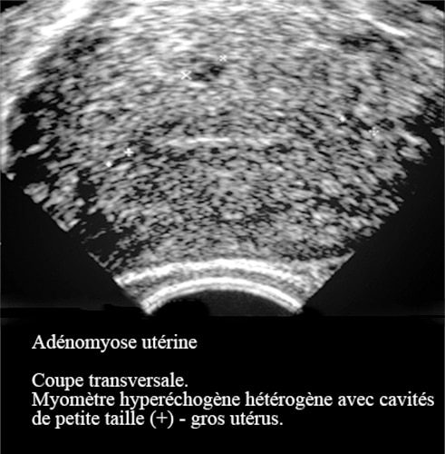 Adenomyose 13