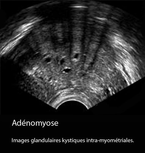 Adénomyose 14