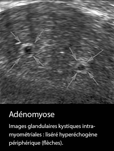 Adénomyose 15