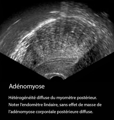 Adénomyose 16