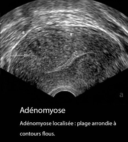 Adénomyose 17