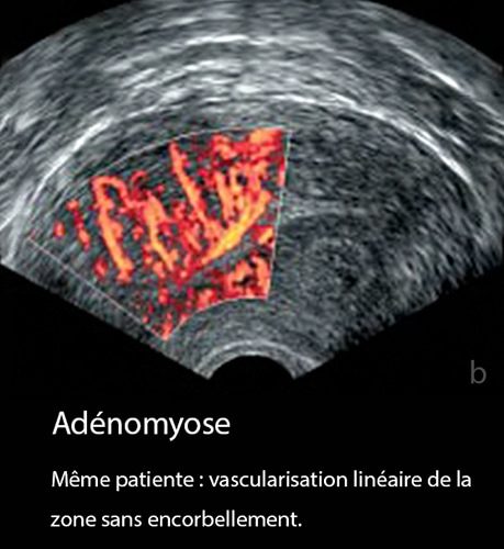Adénomyose 18