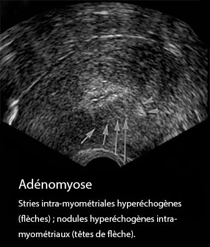 Adénomyose 19