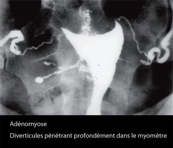 Adénomyose 2
