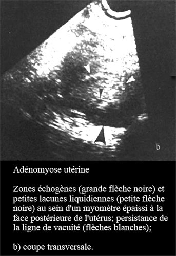 Adenomyose 2
