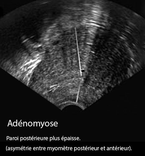 Adénomyose 21