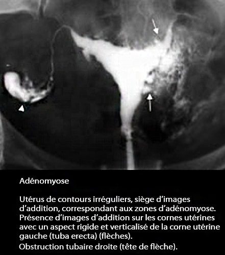 Adénomyose 3
