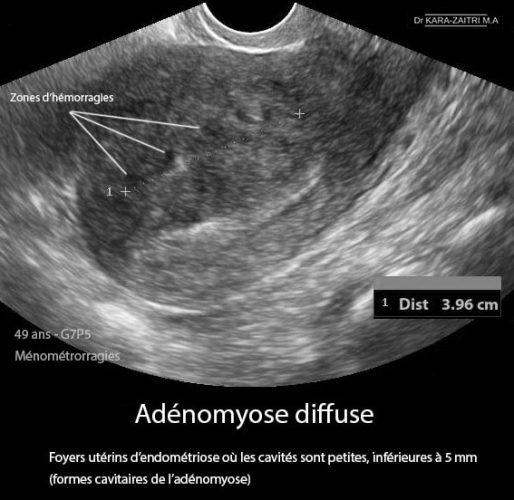 Adénomyose 3