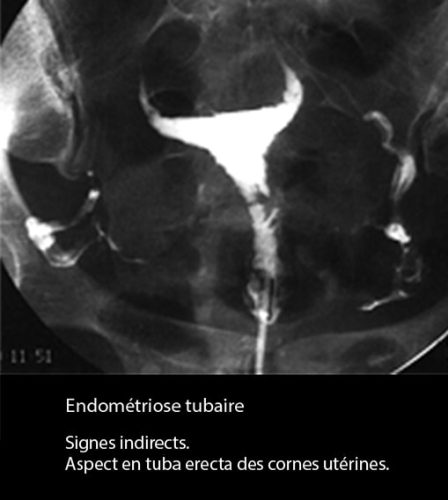 Adénomyose 4