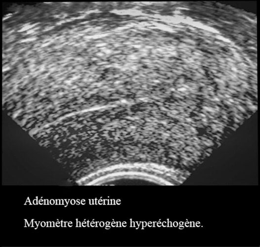 Adenomyose 4