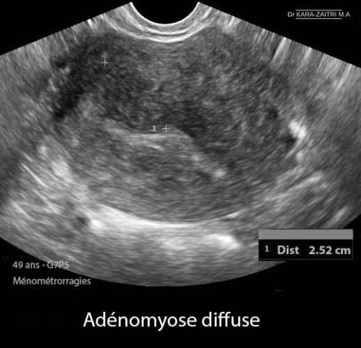 Adénomyose 4