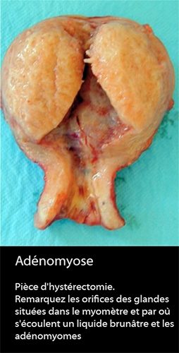 Adénomyose