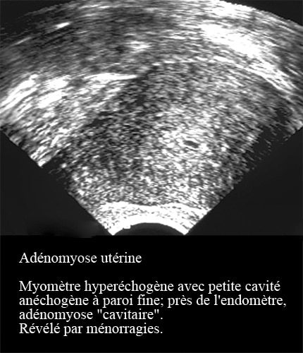 Adenomyose 5