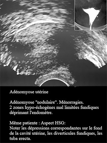 Adenomyose 7
