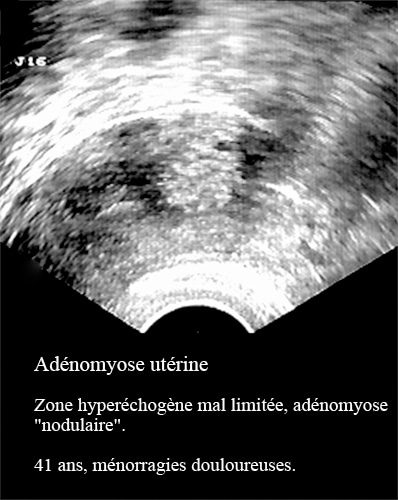 Adenomyose 8