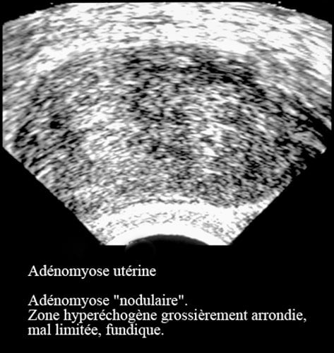 Adenomyose 9