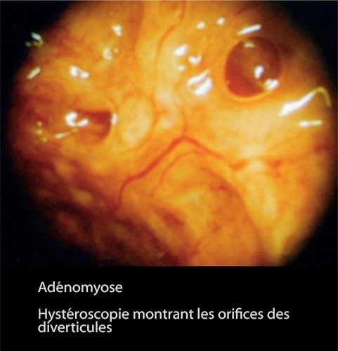 Adénomyose