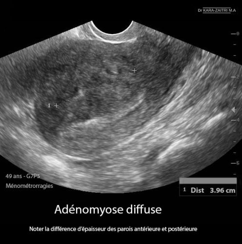 Adénomyose — image échographique utérine aspect hétérogène 1