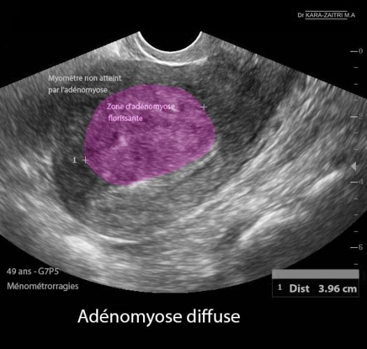 Adénomyose — image échographique utérine aspect hétérogène 2