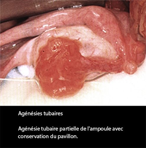Agénésie tubaire coelioscopie — absence congénitale de trompe 2