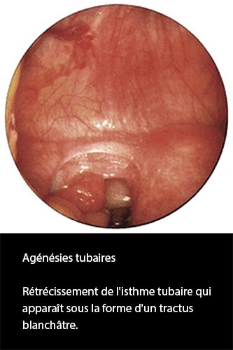 Agénésie tubaire coelioscopie — absence congénitale de trompe 3