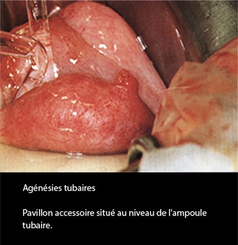 Agénésie tubaire coelioscopie — absence congénitale de trompe 5