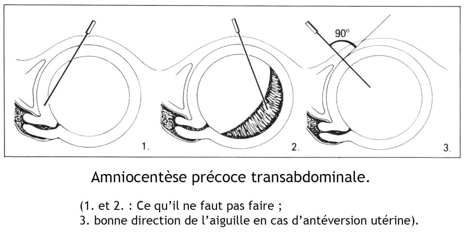 Amniocentese precoce 1