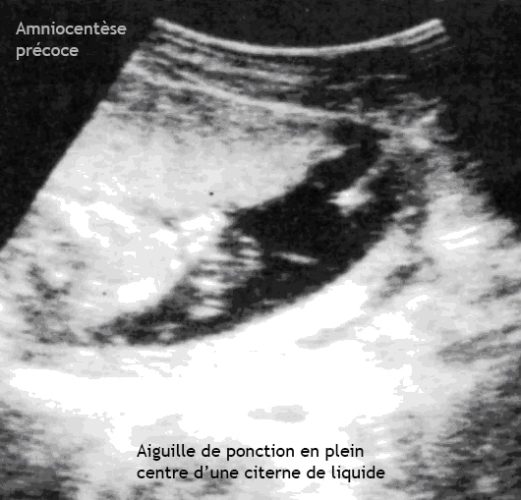 Amniocentese precoce 3