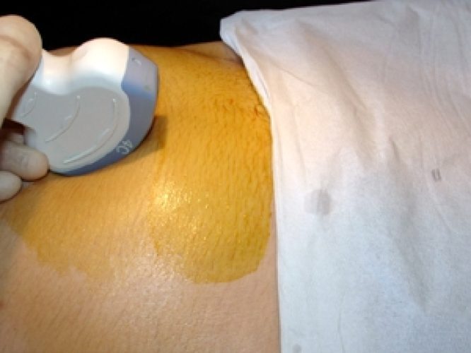 Amniocentèse tardive — prélèvement liquide amniotique 2