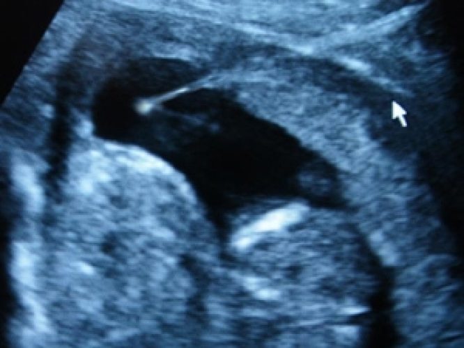 Amniocentèse tardive — prélèvement liquide amniotique 6