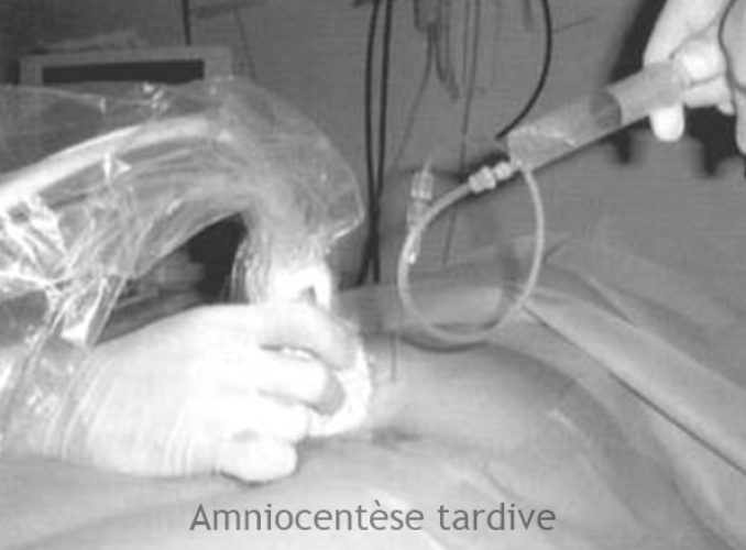 Amniocentèse tardive — prélèvement liquide amniotique 8