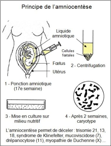 Amniocentese_principe
