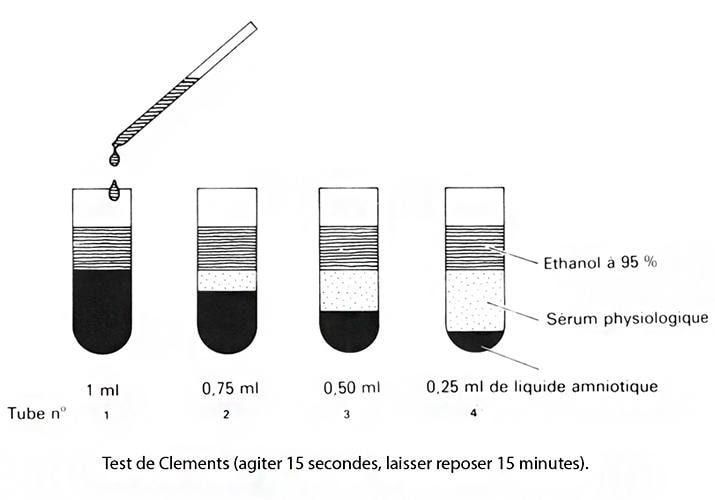 Amniocentèse test de Clements — maturité pulmonaire fœtale